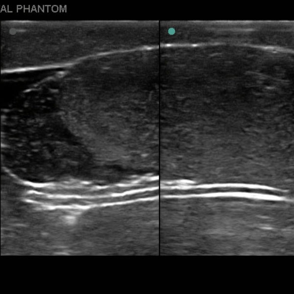 Heartsmart Blue Phantom Scrotal Ultrasound Training Model