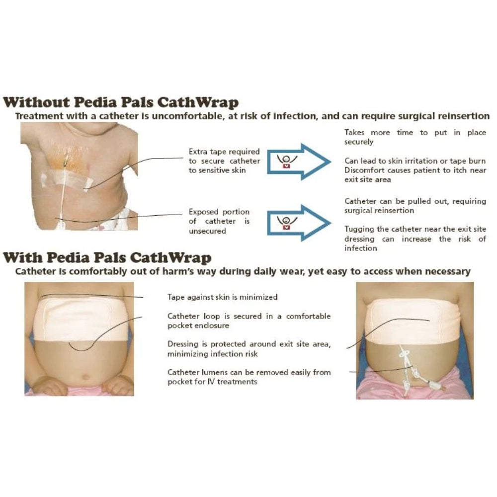 Pediatric Catheter Wrap CathWrap