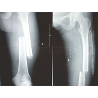 FareTec CT-6 Leg Traction Splint Tactical