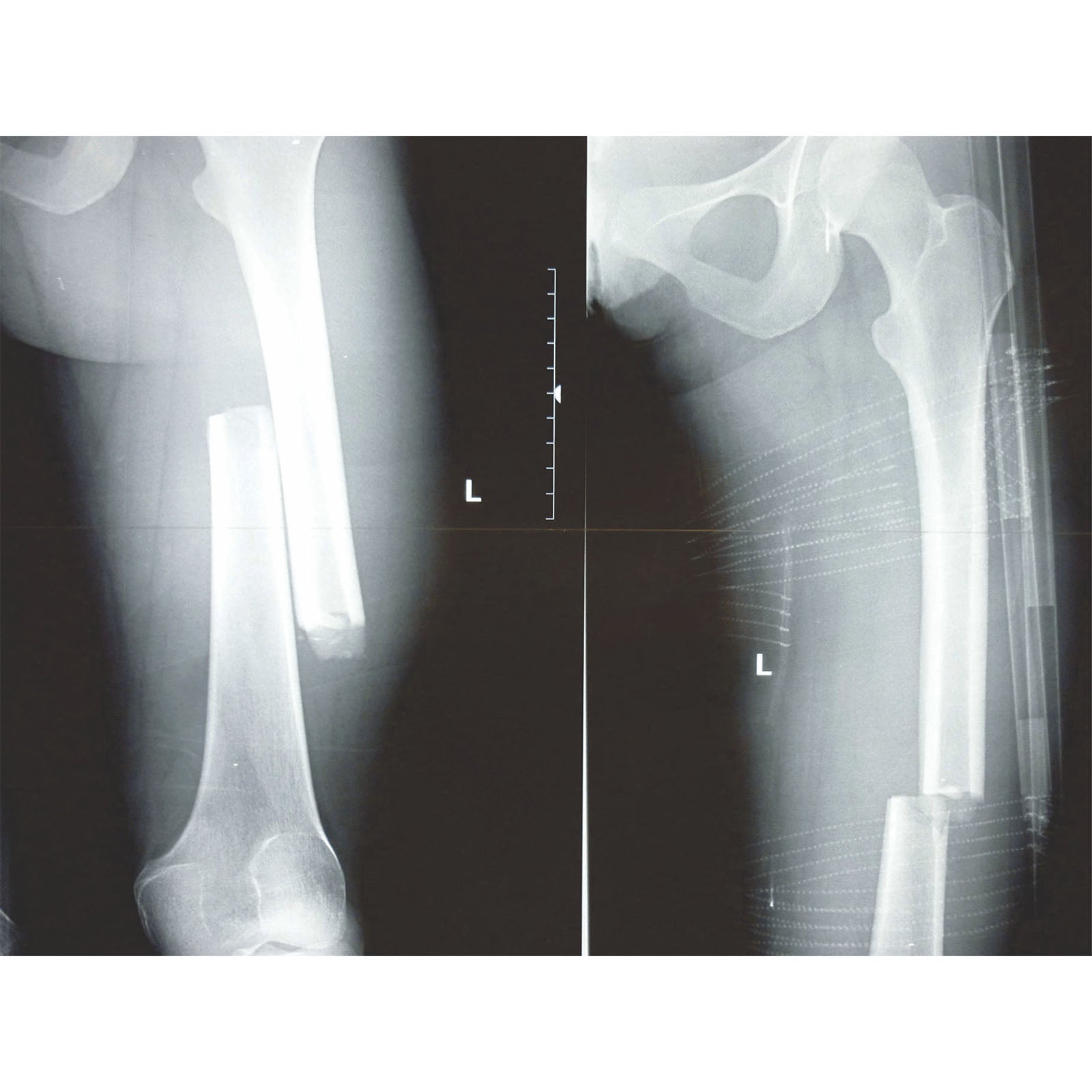 FareTec CT-6 Leg Traction Splint Tactical