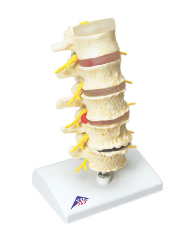 3B Scientific Anatomical Model - vertebrae degeneration, stages of prolapsed disc - Includes 3B Smart Anatomy — for Anatomical Models in Clinical and Institutional Care