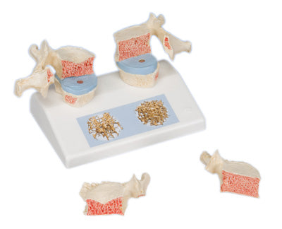 3B Scientific Anatomical Model - osteoporosis model - Includes 3B Smart Anatomy — for Anatomical Models in Clinical and Institutional Care