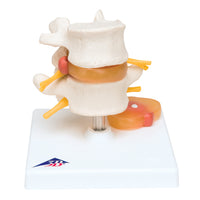 3B Scientific Anatomical Model - Lumbar Spinal Column with Prolapsed Intervertebral Disc - Includes 3B Smart Anatomy — for Anatomical Models in Clinical and Institutional Care