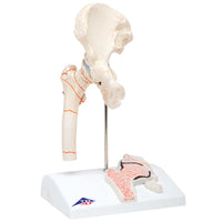 3B Scientific Anatomical Model - Femoral Fracture and Hip Osteoarthritis - Includes 3B Smart Anatomy — for Anatomical Models in Clinical and Institutional Care