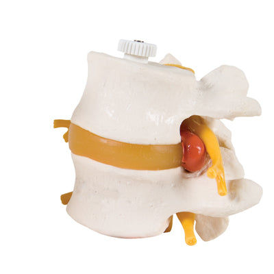 3B Scientific Anatomical Model - 2 Lumbar Vertebrae with prolapsed disc, flexibly mounted - Includes 3B Smart Anatomy — for Anatomical Models in Clinical and Institutional Care