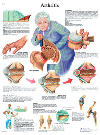 3B Scientific Anatomical Chart - arthritis, paper — for Anatomical Charts in Clinical and Institutional Care