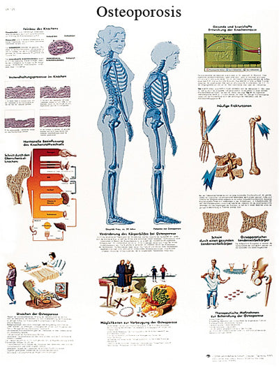 3B Scientific Anatomical Chart - osteoporosis, laminated — for Anatomical Charts in Clinical and Institutional Care