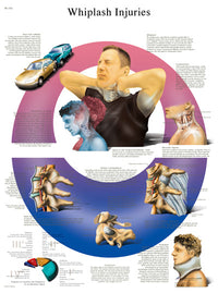 3B Scientific Anatomical Chart - whiplash, paper — for Anatomical Charts in Clinical and Institutional Care