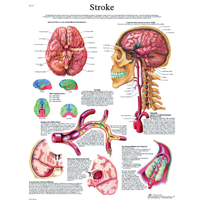 3B Scientific Anatomical Chart - stroke chart, laminated — for Anatomical Charts in Clinical and Institutional Care