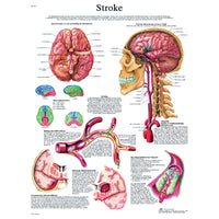 3B Scientific Anatomical Chart - stroke chart paper — for Anatomical Charts in Clinical and Institutional Care