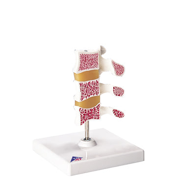 3B Scientific Anatomical Model - Deluxe Osteoporosis Model (3 Vertebrae) - Includes 3B Smart Anatomy — for Anatomical Models in Clinical and Institutional Care