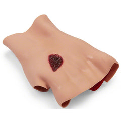 Simulaids Hand with Phosphorus Burn